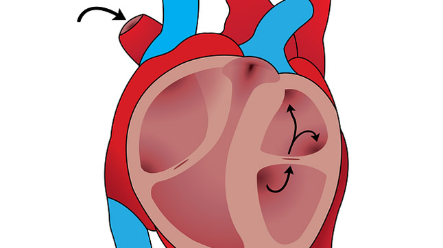 ¿Cuál es el pronóstico de la cardiopatía isquémica?