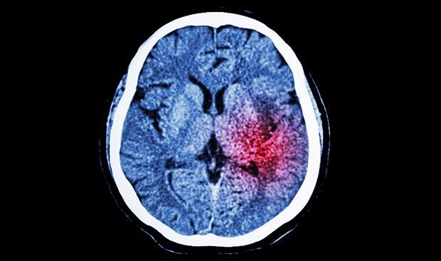 Covid: contar con una red de atención al ictus mejora las secuelas