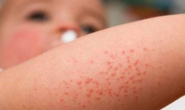 Dermatitis atópica en niños: problemas de