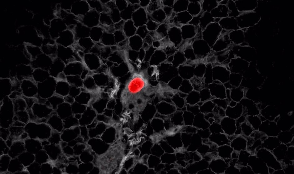 Descubren las células responsables de la recaída en el cáncer de colon