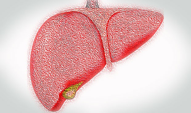 Diagnóstico precoz en colangitis biliar: clave para no ser incapacitante