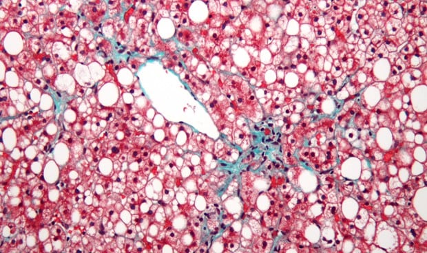 Uno de cada 5 casos de esteatosis hepática no alcohólica deriva en cirrosis