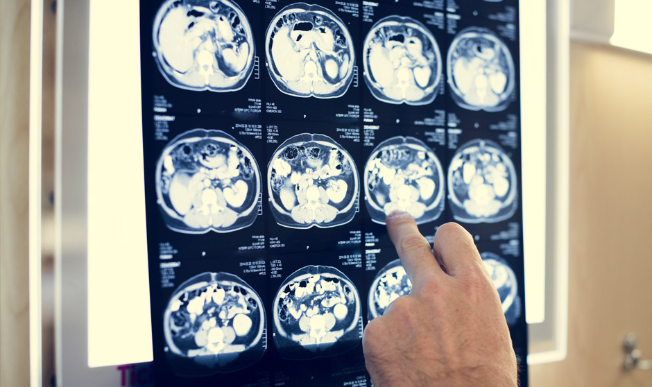 Neurología pide actuar en fases preclínicas para prevenir con éxito daños en la salud cerebral 