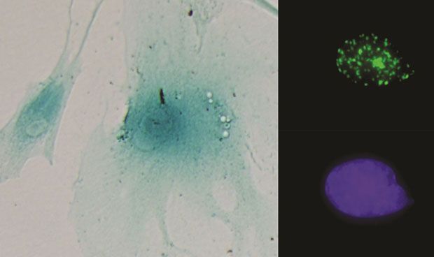 Hallan un circuito celular que aumenta el crecimiento del cáncer de colon