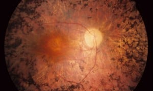 HLA Montpellier pone el foco sobre la retinosis pigmentaria