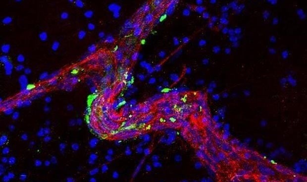 Identifican la proteína causante de metástasis cerebrales de mama y pulmón