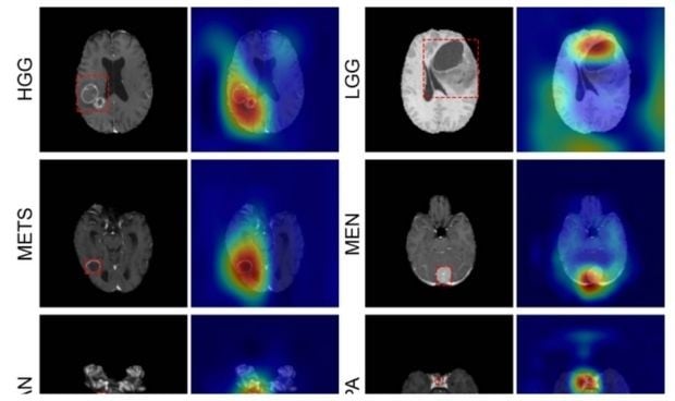 imágenes de resonancia magnética del cerebro