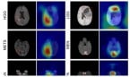 La IA detecta y clasifica los tumores cerebrales con resonancia magnética