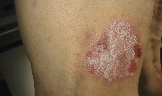 Las células madre portan una clave sobre el origen de la psoriasis