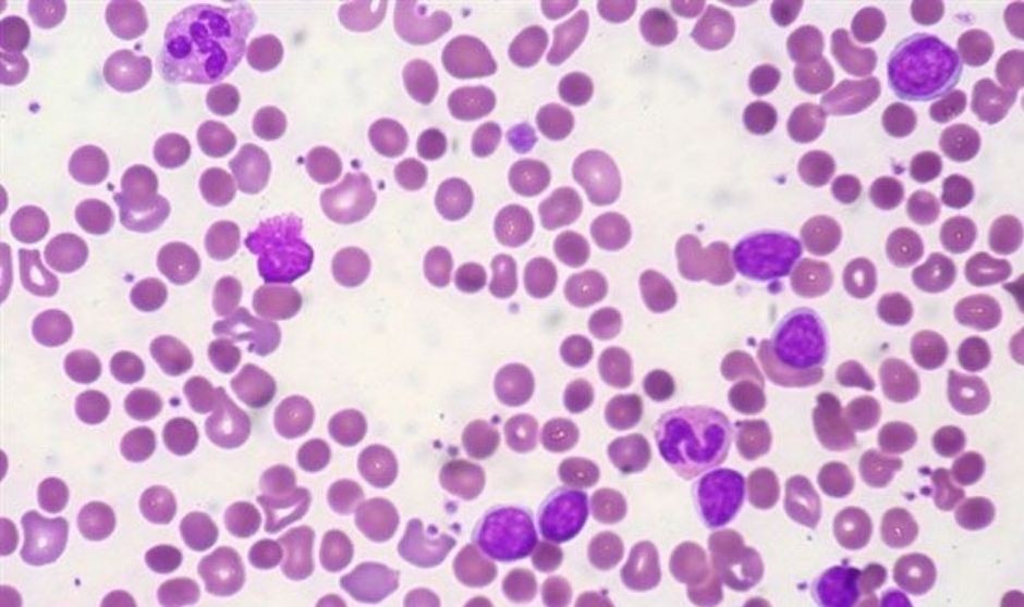 La mesotelina, "diana diagnóstica y terapéutica" para niños con leucemia