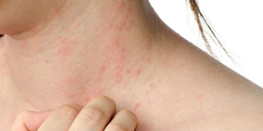 Los niños con dermatitis atópica faltan una media de 10 y 24 días a clase