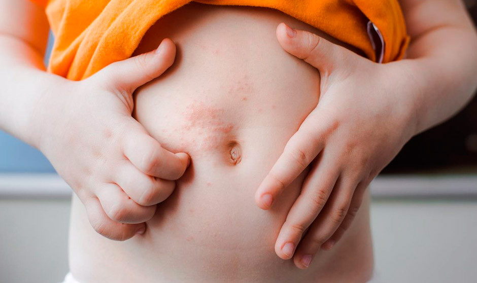 Dermatitis atópica en niños: mejor tratamiento y sus efectos adversos