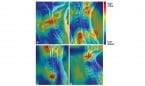 Un algoritmo supera a neurocirujanos en predicción del segmento adyacente