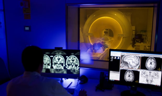 Una investigación con una nueva secuencia de resonancia magnética identifica que el flujo sanguíneo cerebral disminuye en etapas asintomáticas del Alzheimer