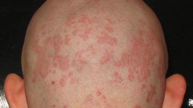 Dermatitis seborreica. Trastorno en mi piel