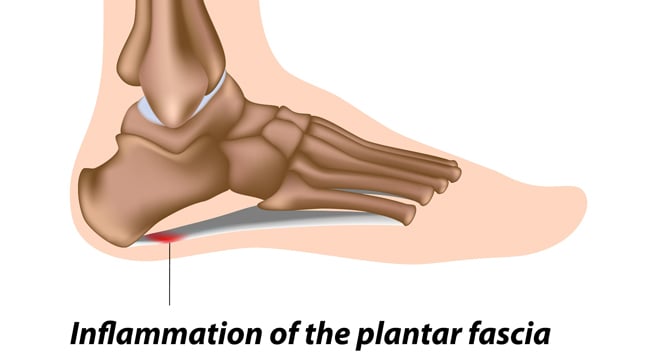 La Fascitis plantar es un padecimiento que ocurre, debido a la inflamación  del tejido fibroso de la planta del pie, provocado generalmente…